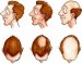 gubitak-kose-alopecia-androgenetica